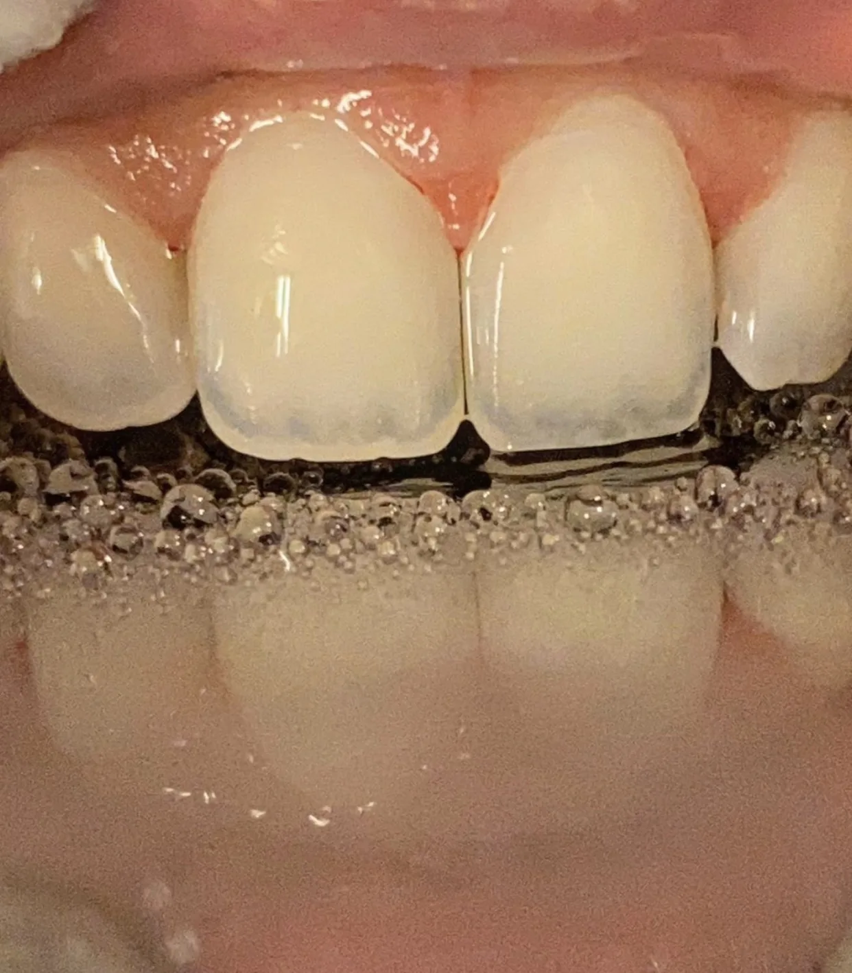 Detalhe de um sorriso após tratamento estético na NASP Odontologia